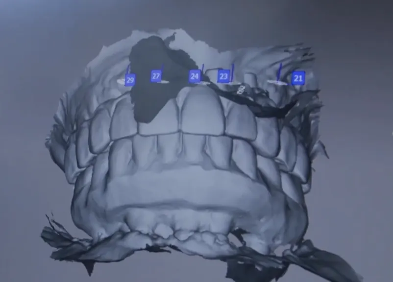 3D scan of the teeth with individual teeth numbered for treatment