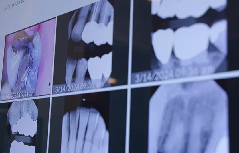 Designing the teeth first during implant denture treatment