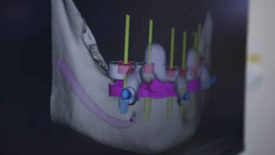 Digital implant plan for a lower jaw at Overland Park Dental Design