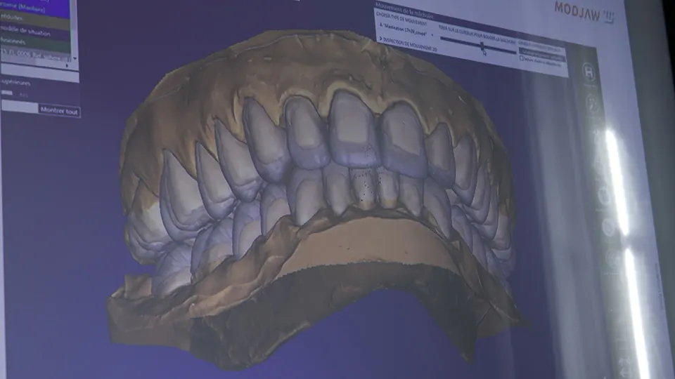 Digital scan of the upper and lower teeth shown on a monitor