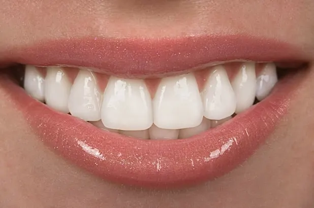 Porcelain veneers at Overland Park Dental Design