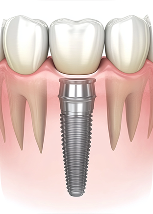 7 Life-Changing Benefits of Dental Implants: What Patients Need to Know