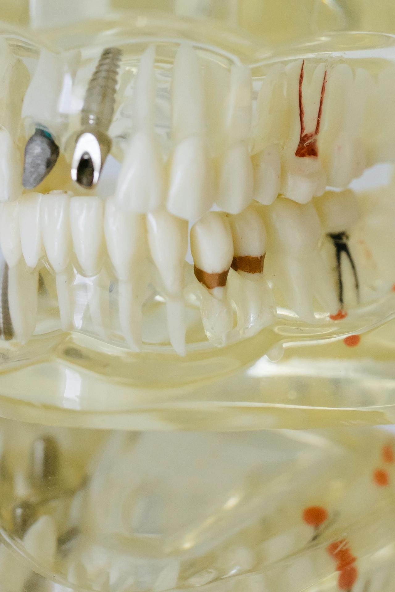 Dental Veneers vs. Dental Crowns: Which One is Right for You?