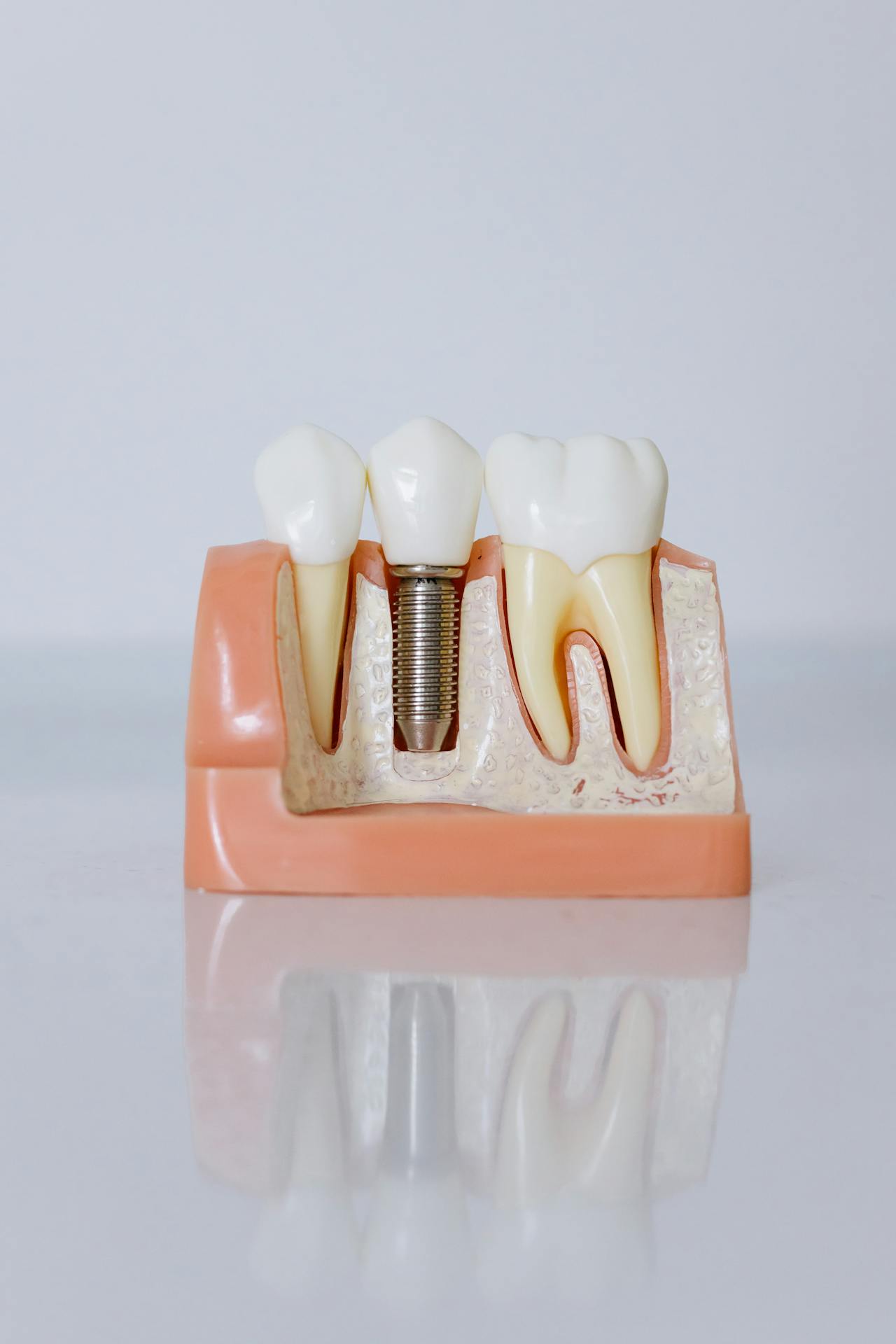 Pros and Cons of All-on-4 Dental Implants in Leawood, KS
